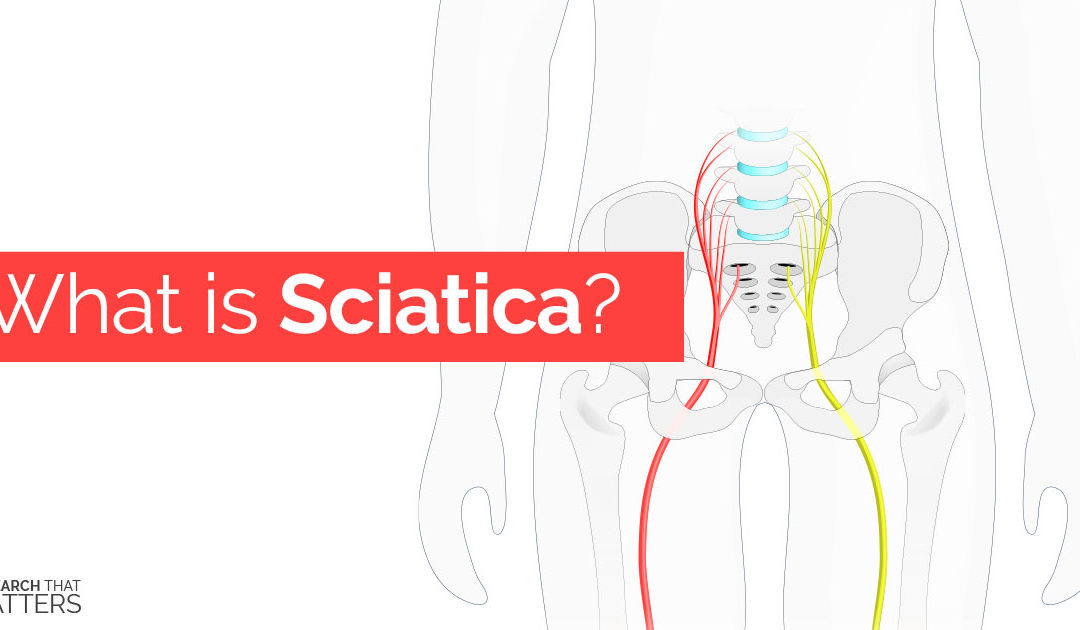 What is Sciatica?